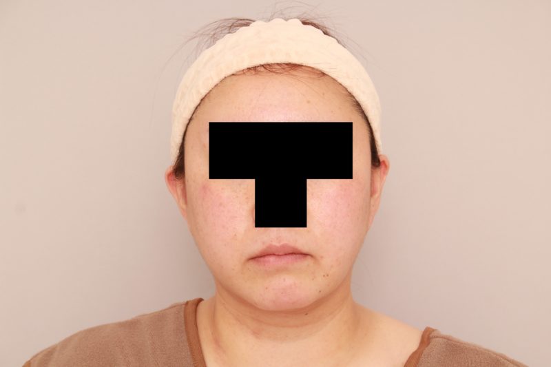 ほほ顎脂肪吸引3週間後の変化(150㏄吸引した方)