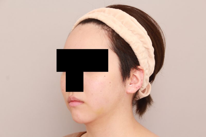 ほほ顎脂肪吸引の細かな経過