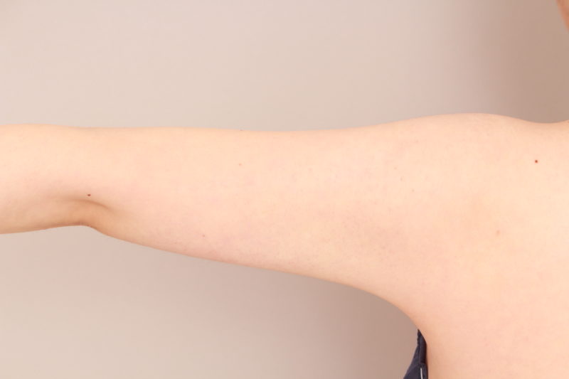 二の腕の脂肪吸引1か月後
