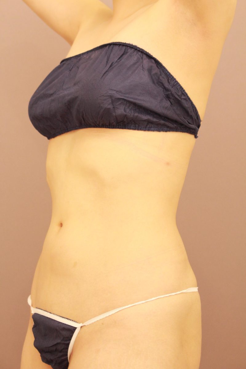 お腹、腰脂肪吸引3か月後