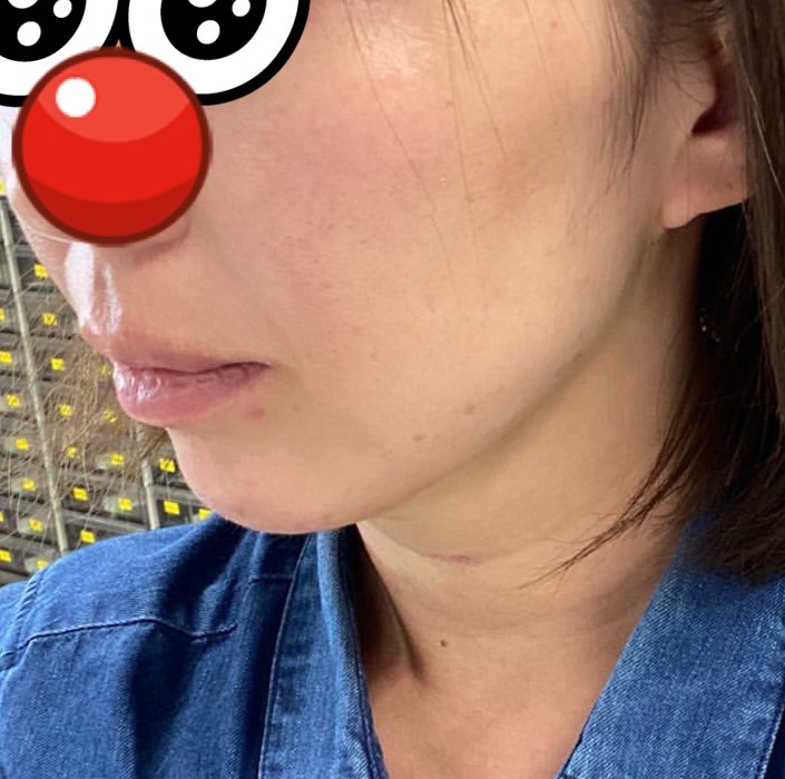 ほほ顎脂肪吸引のモニター様の翌日