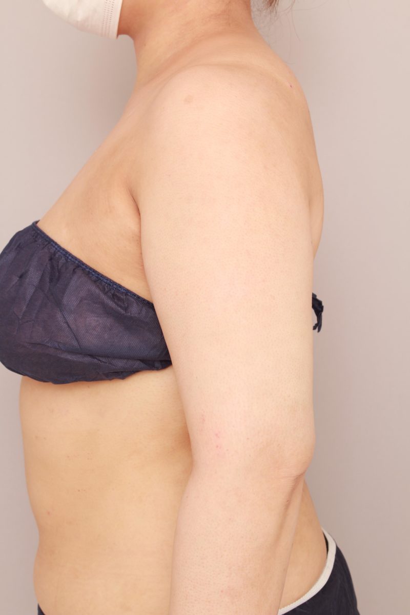 二の腕、肩の脂肪吸引1か月後