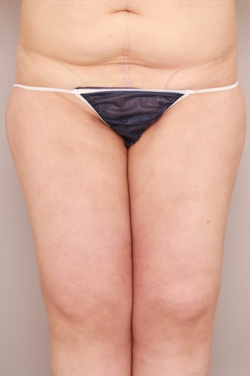 太もも全周、お尻の脂肪吸引のモニター様1か月後