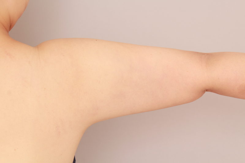 二の腕、肩の脂肪吸引のモニター様1か月後