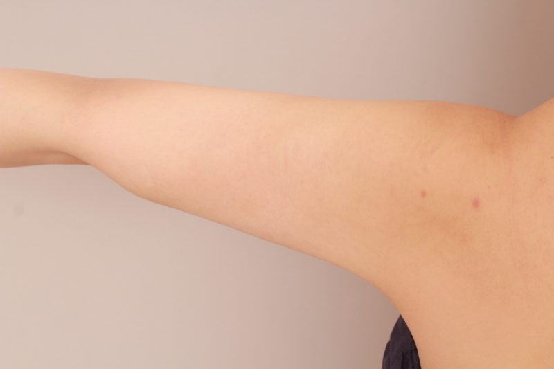 二の腕、肩の脂肪吸引1か月後