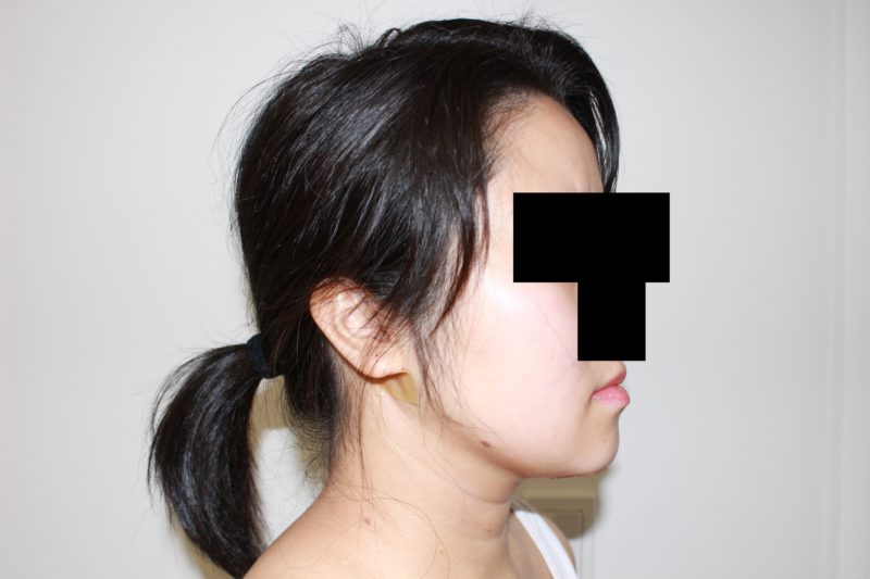 ほほ顎脂肪吸引のモニター様翌日の様子