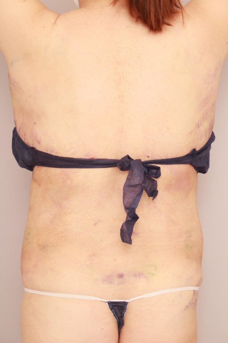 腰、肩甲骨上下の脂肪吸引モニター様の翌日の様子