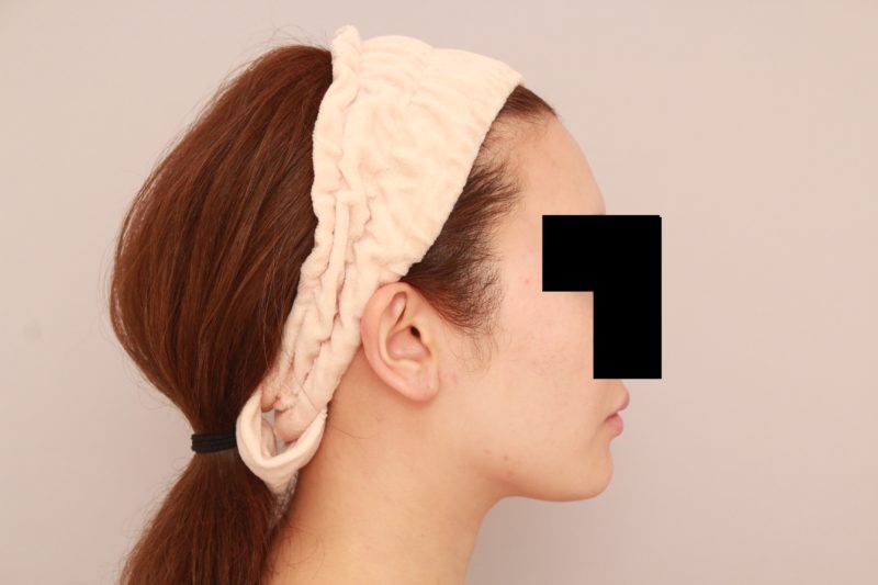 ほほ顎脂肪吸引３か月後