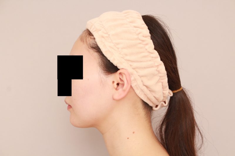 もともと痩せていらっしゃる方のほほ顎脂肪吸引1か月後