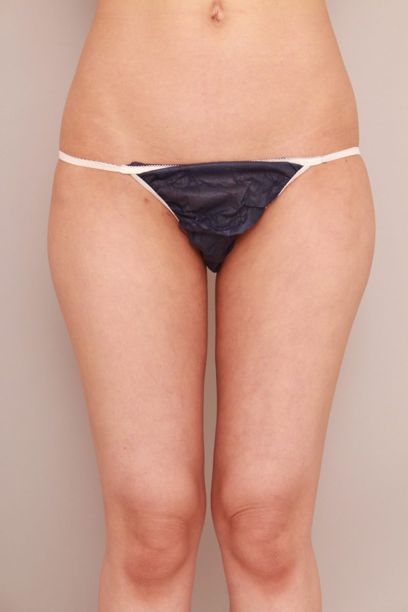 太もも全周、お尻の脂肪吸引1か月後