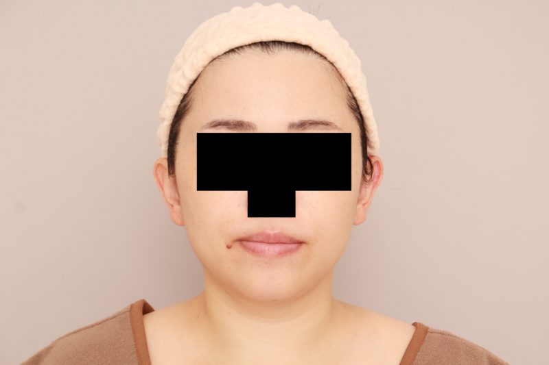 ほほ顎脂肪吸引1か月後