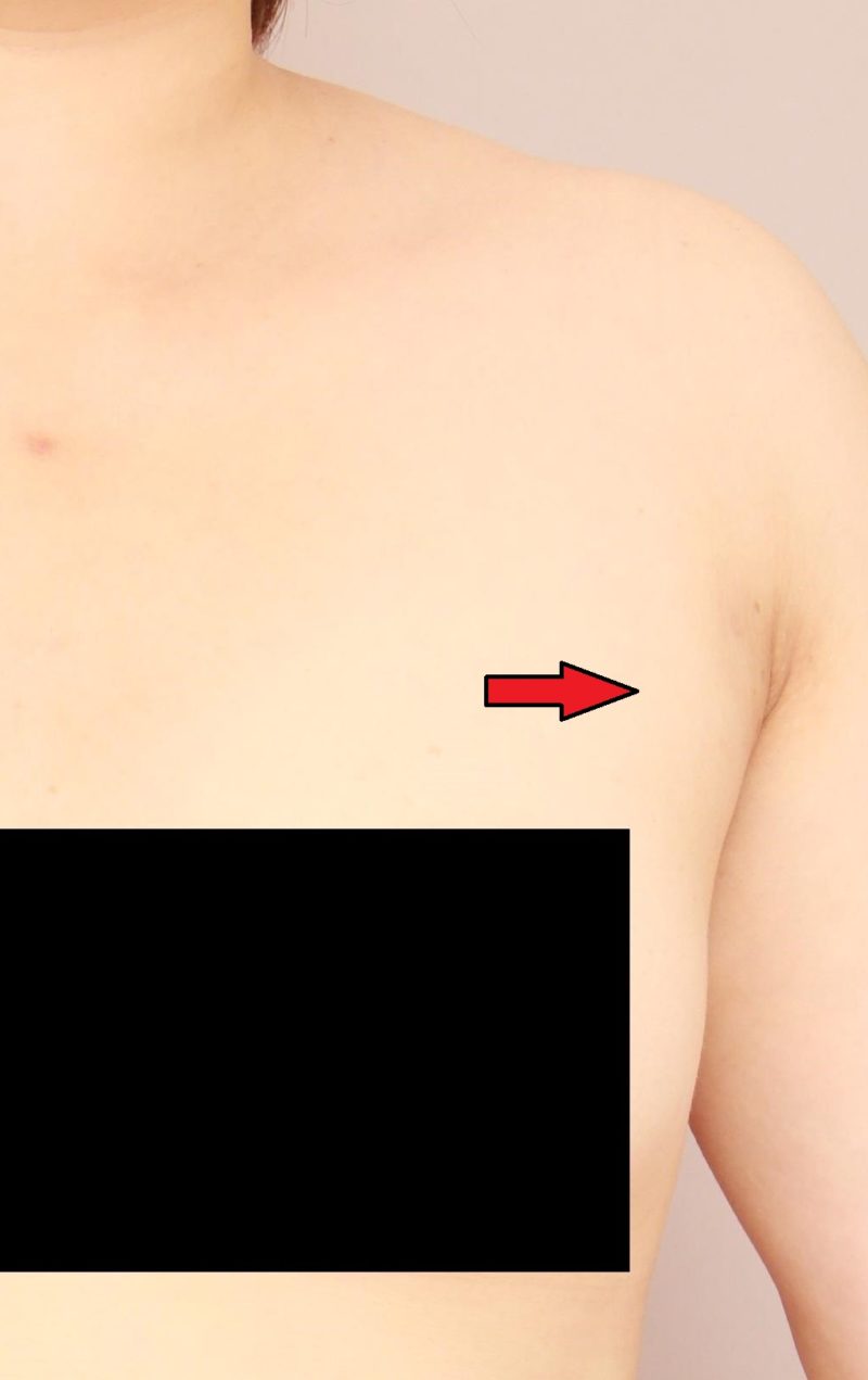 実は人気！！「脇肉」の脂肪吸引1か月後