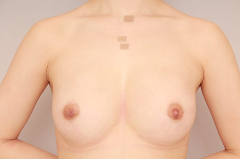 コンデンスリッチ豊胸1か月後