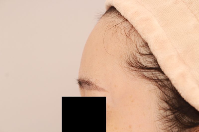 おでこ、こめかみの脂肪注入1か月後