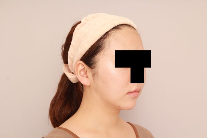 ほほ顎脂肪吸引3か月後