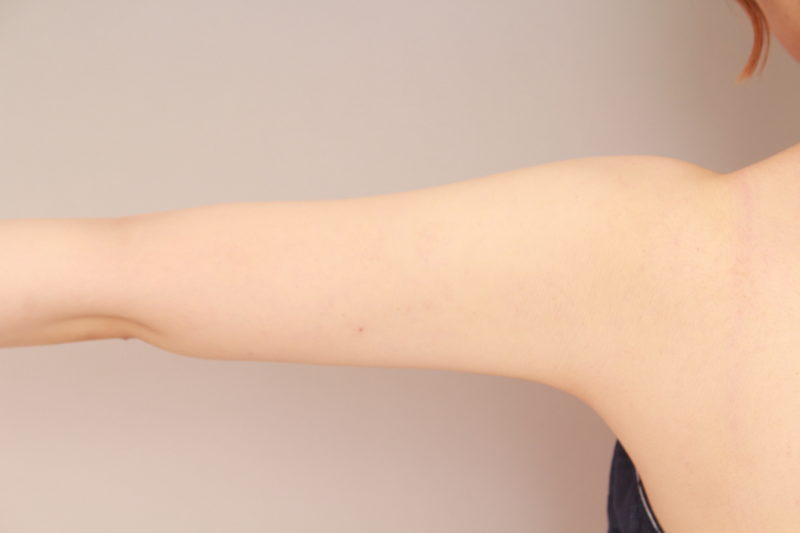 二の腕、肩の脂肪吸引3か月後