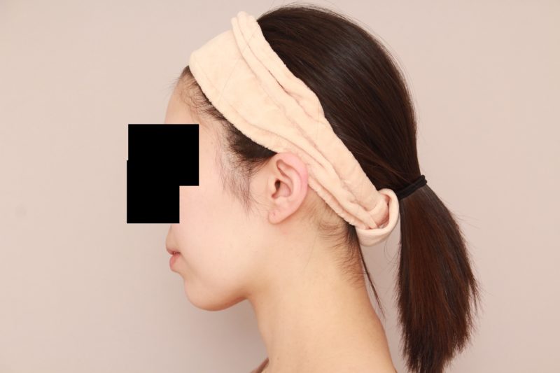 ほほ顎脂肪吸引のモニター様3か月後