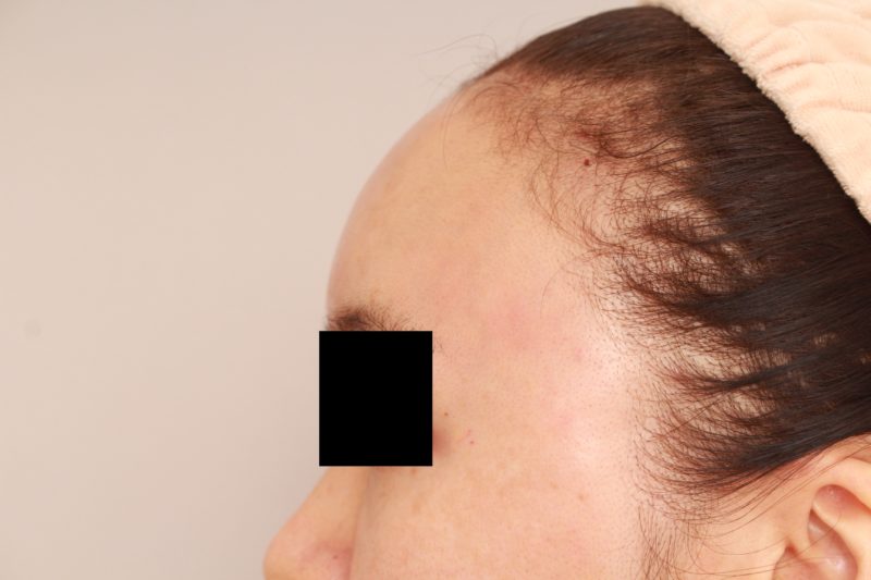 おでこ、こめかみのコンデンスリッチファット注入