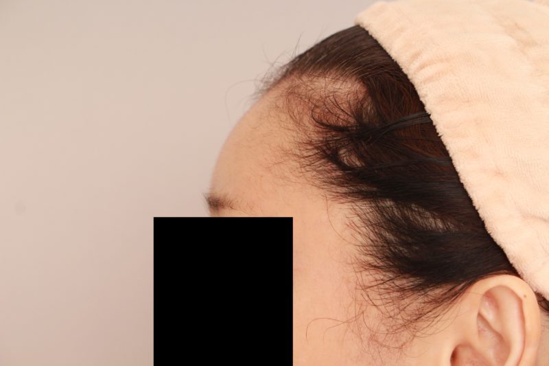 おでこ、こめかみの脂肪注入で若返り