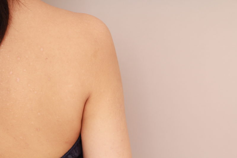 二の腕、肩の脂肪吸引1か月後