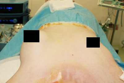 抜去後のバスト