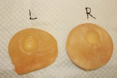抜去したシリコンバッグ