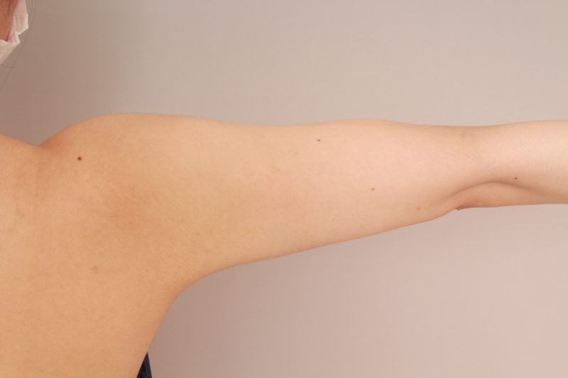 二の腕、肩の脂肪吸引3か月後