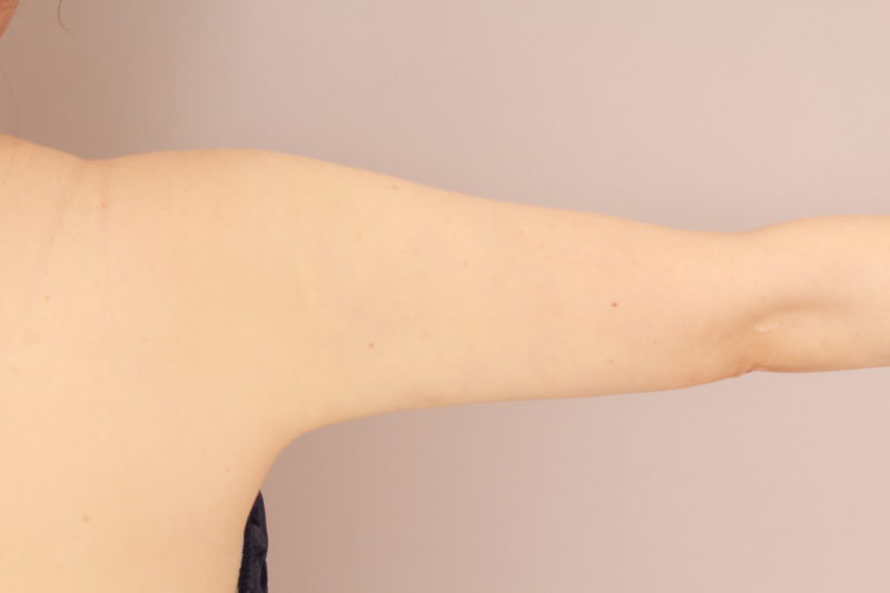 二の腕、肩の脂肪吸引1か月後