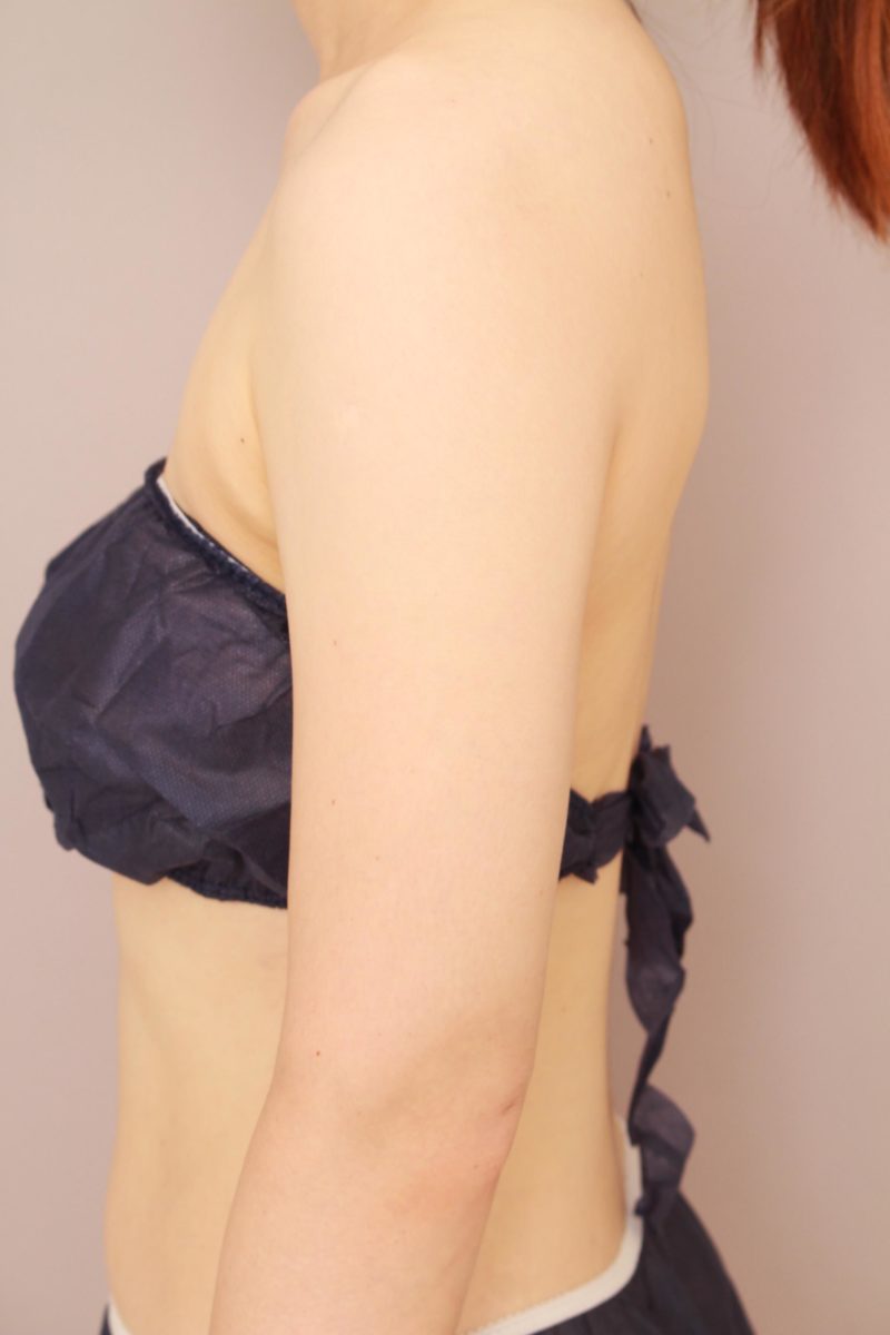 二の腕、肩の脂肪吸引3か月後