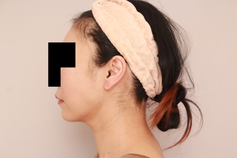 ほほ顎脂肪吸引3か月後