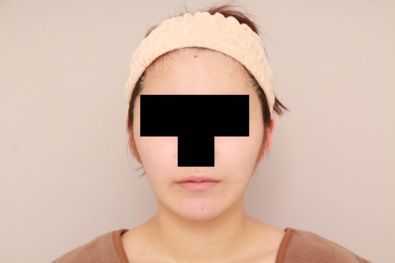 ほほ顎脂肪吸引1か月後のモニター様