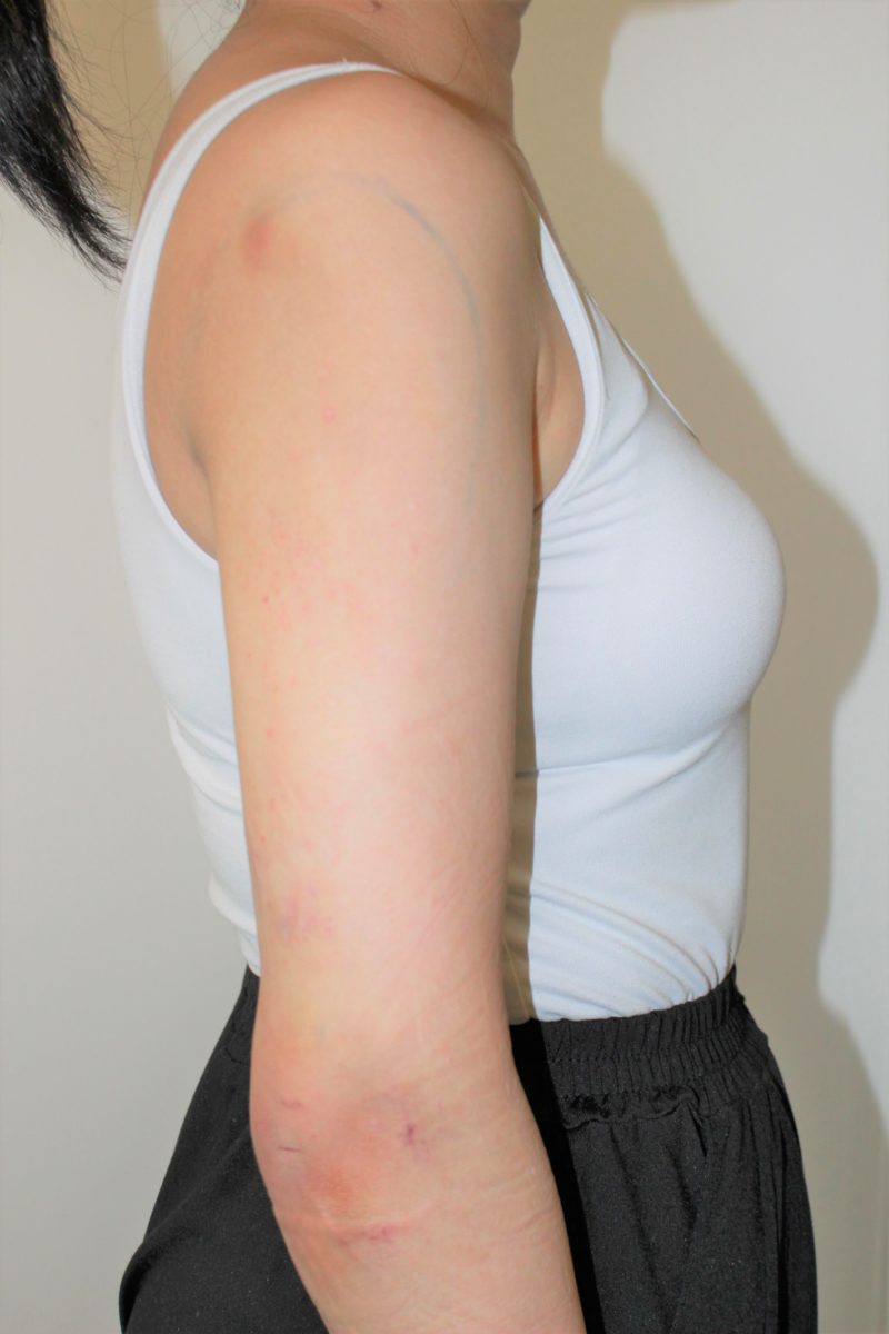 二の腕脂肪吸引の翌日の様子と経過について