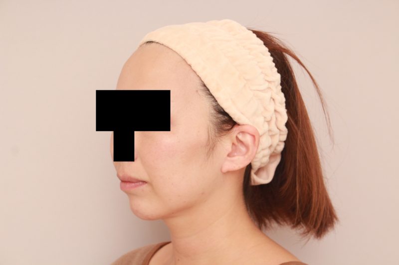 ほほ顎脂肪吸引1か月後