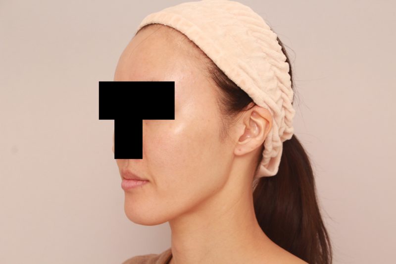 脂肪注入でエイジングケア1か月後