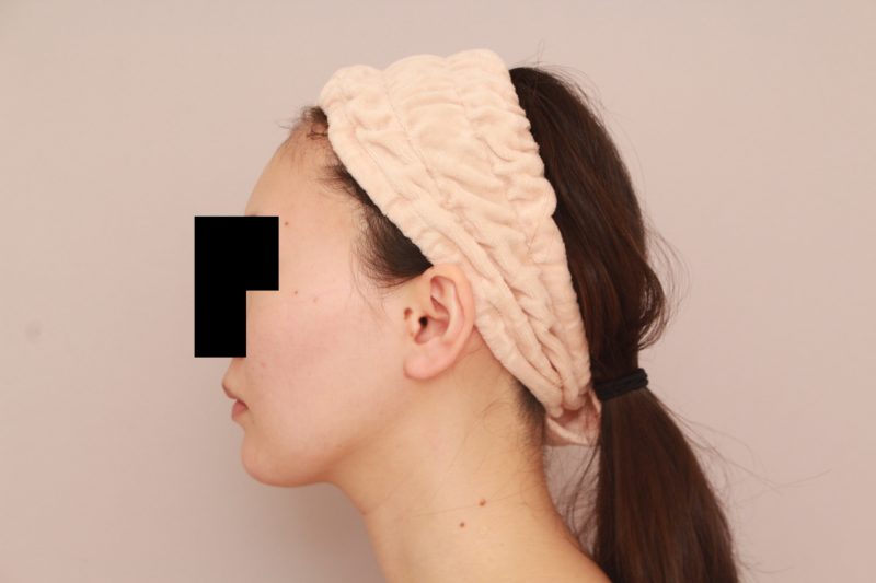 痩せている方のほほ顎脂肪吸引3か月後