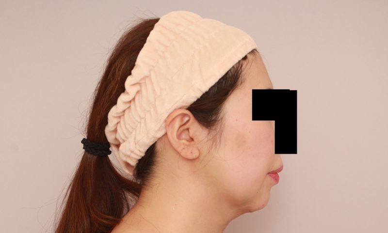 ほほ顎脂肪吸引の翌日の様子(あまり麻酔液が出なかったタイプ)