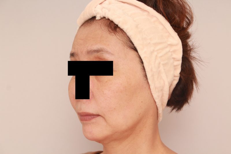 コンデンスリッチ脂肪注入でエイジングケア3か月後