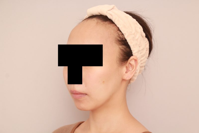 ほほ顎脂肪吸引3か月後