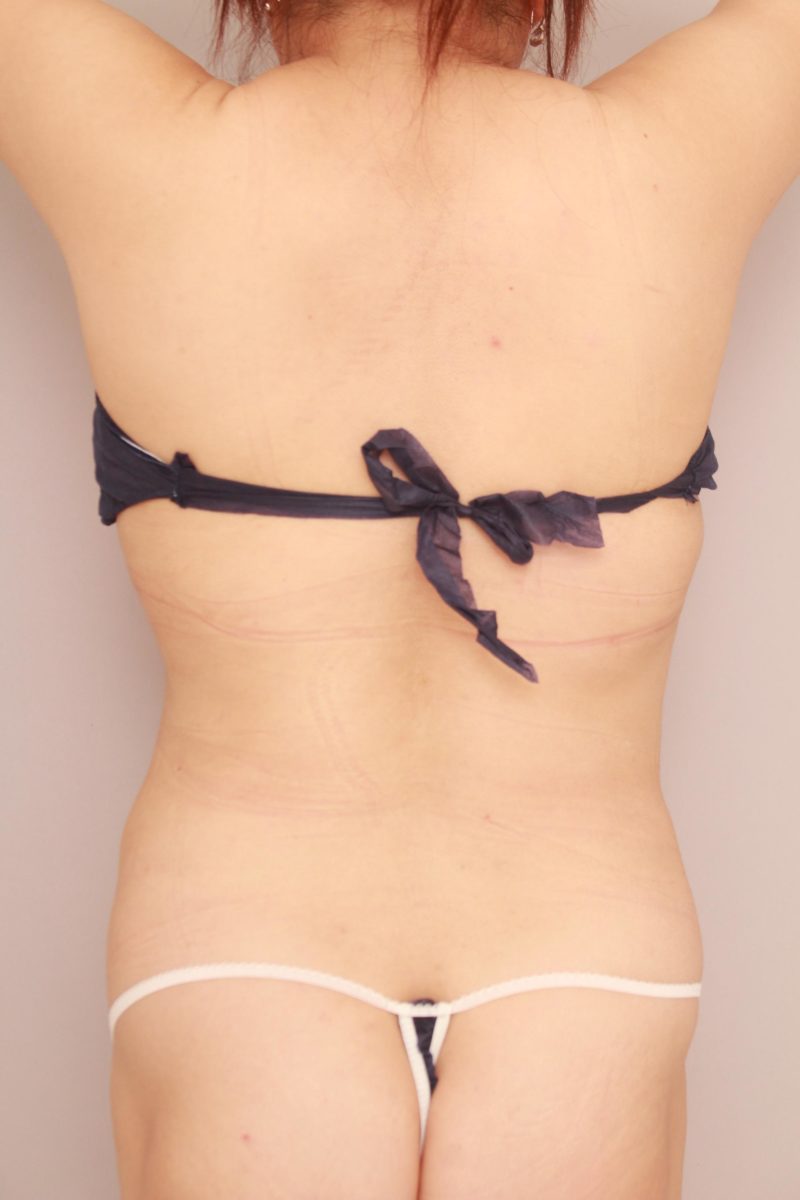 腰の脂肪吸引3か月後