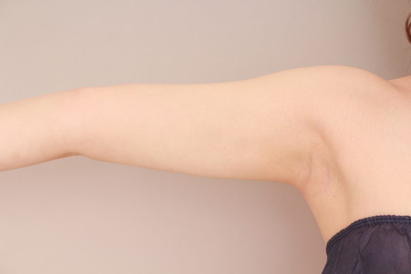 二の腕、肩の脂肪吸引3か月後