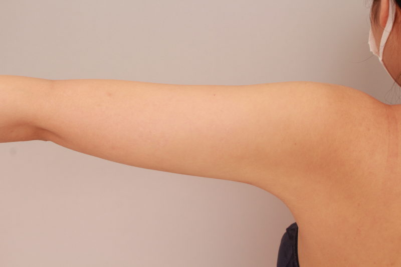 二の腕、肩の脂肪吸引1か月後