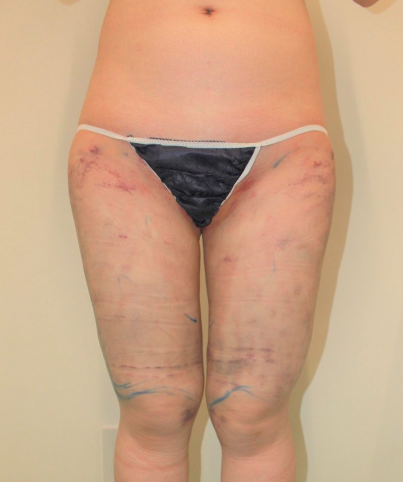 太もも全周、お尻の脂肪吸引の翌日の様子