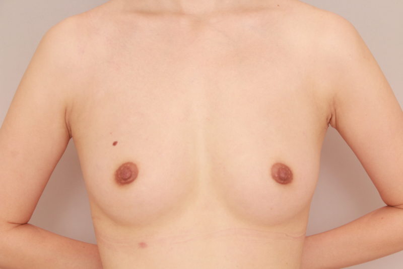 コンデンスリッチ脂肪注入豊胸1か月後