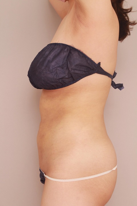 お腹・腰の脂肪吸引 術後1カ月の経過