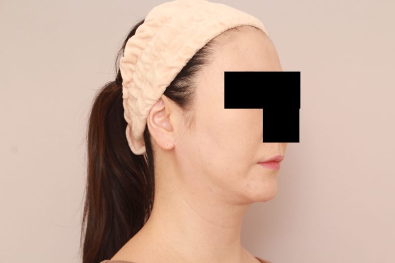 ほほ顎脂肪吸引のモニター様3か月後