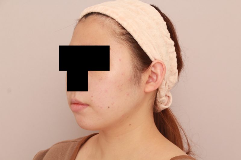 ほほ顎脂肪吸引のモニター様1か月後