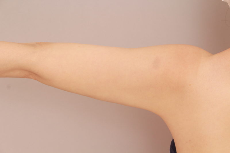 二の腕、肩の脂肪吸引1か月後