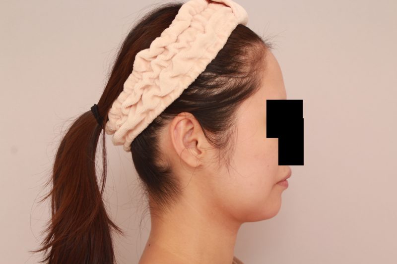 ほほ顎脂肪吸引1か月後