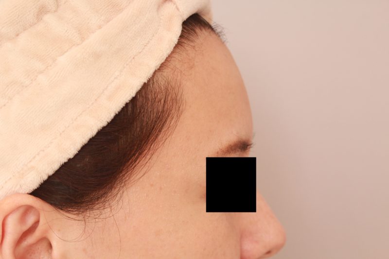 オデコ、こめかみの脂肪注入4か月後