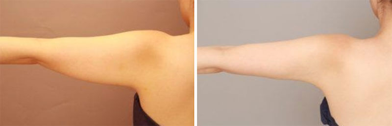 二の腕・肩の脂肪吸引　術後1カ月の経過／北條誠至オフィシャルブログ